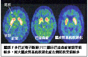 大腦皮質基底核退化症示意圖